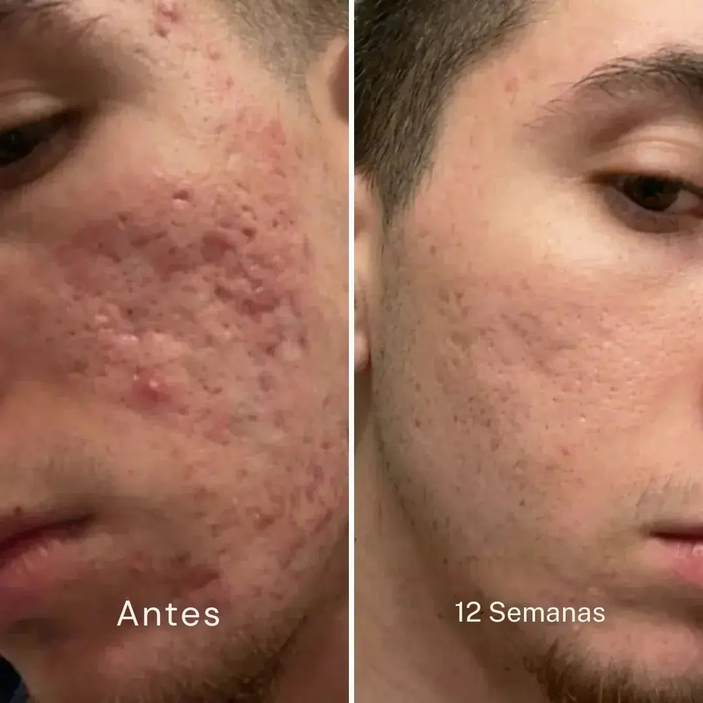 BARRA REPARADORA DE CICATRICES DE ACNÉ